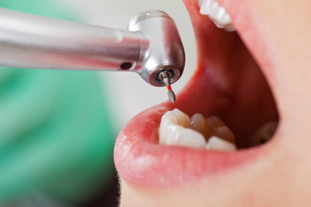 Best Emergency Dental Care for Broken or Chipped Teeth in Cowan, TN